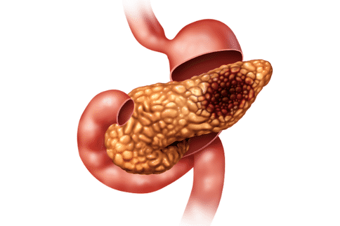 胰腺神经内分泌肿瘤是什么？应该如何治疗胰腺神经内分泌肿瘤？