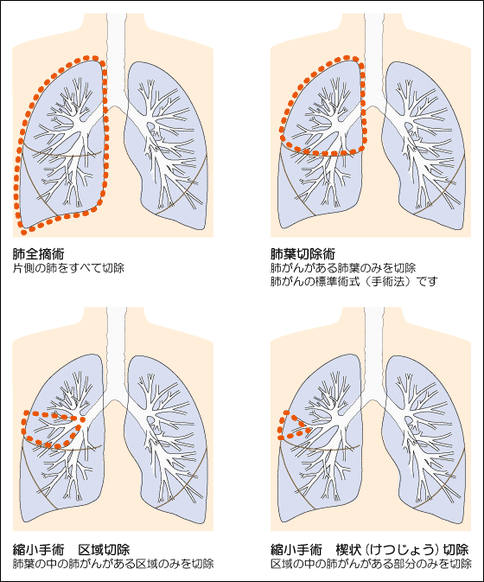 lung07.png