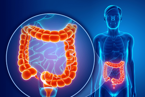 日本新研究发现胃切除术后患者出现大肠癌的几率增加！