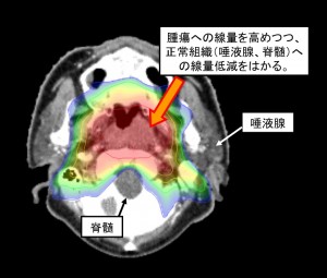 调强放疗治疗鼻咽癌