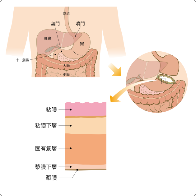 晚期胃癌