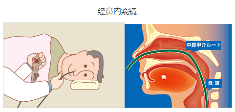 日本电子胃镜