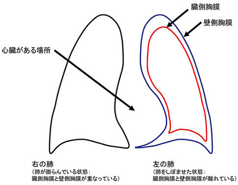 恶性胸膜间皮瘤