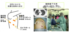 肺转移日本治疗,日本质子重离子治疗转移性肺癌