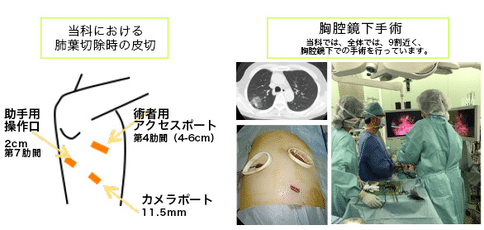 腹腔镜手术治疗转移性肺癌