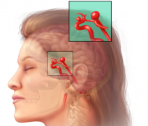 脑动脉瘤治疗,脑动脉瘤,脑动脉瘤复发风险