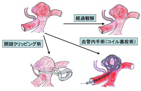 脑血管瘤治疗