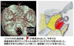 脑动脉瘤治疗,脑动脉瘤,脑动脉瘤复发风险