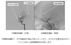 烟雾病治疗方法,烟雾病治疗,治疗烟雾病方法