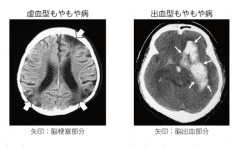 烟雾病治疗方法,烟雾病治疗,治疗烟雾病方法