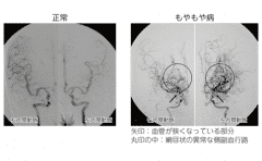 烟雾病治疗方法,烟雾病治疗,治疗烟雾病方法