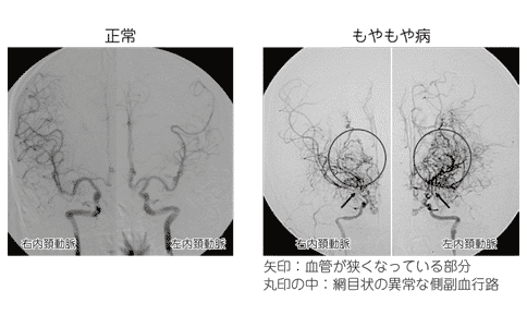 烟雾病治效果果