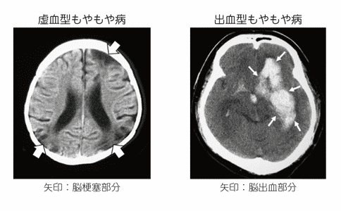 烟雾病预后