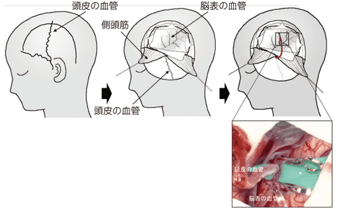 烟雾病手术效果