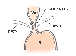 反流性食管炎