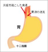 返流性食管炎治疗,返流性食管炎药物治疗,返流性