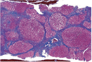 肝硬化组织切片图片