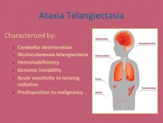 共济失调治疗,共济失调毛细血管扩张症,共济失调