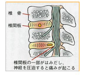 日本治疗腰椎间盘突出-2020日本腰椎间盘突出治疗方法总结