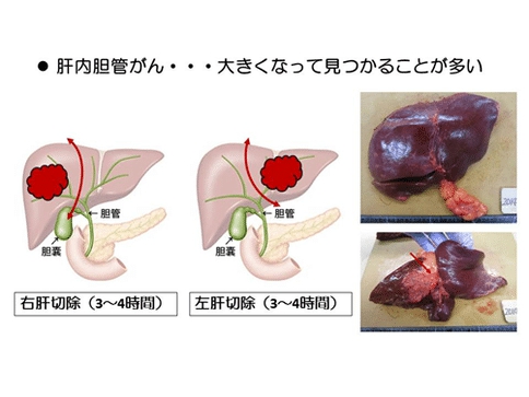 胆管癌手术治疗方案-日本胆管癌权威医院深度分析手术治疗方法