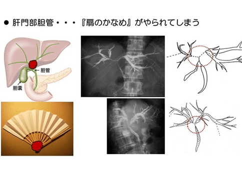 胆管癌手术治疗方案-日本胆管癌权威医院深度分析手术治疗方法