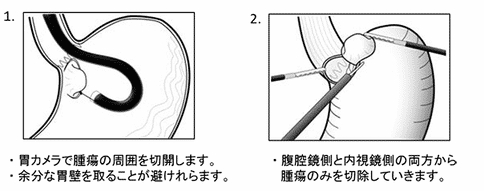 胃肠道间质瘤手术治疗方法介绍,日本医院深度分析