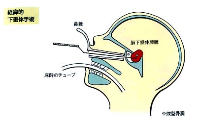 女性脑垂体瘤手术治疗方法