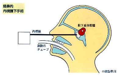 早期脑垂体瘤手术治疗