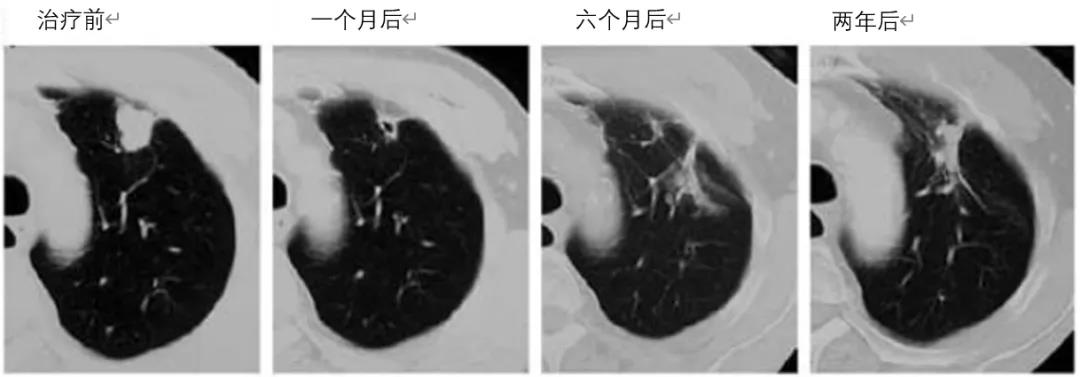 肺癌质子治疗