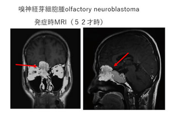 嗅神经母细胞瘤