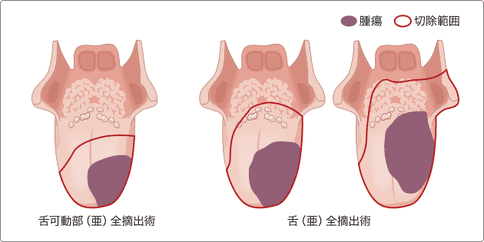 舌癌,舌癌治疗,舌癌治疗专家