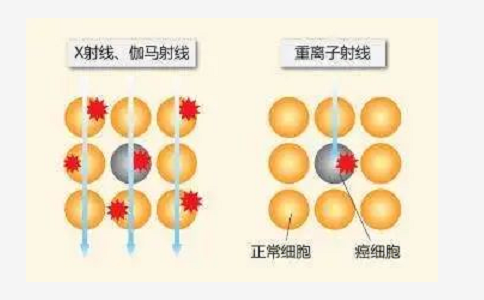 质子重离子治疗