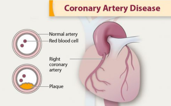 冠心病寿命,冠心病生存期,冠心病治疗