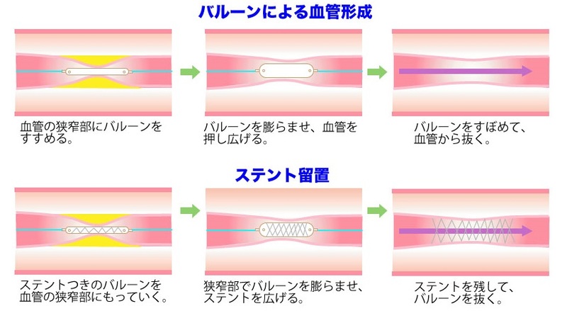 冠心病介入治疗