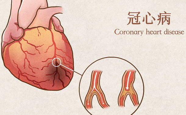 冠心病治疗