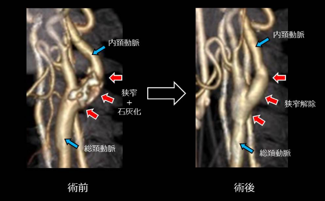 轻度颈动脉狭窄治疗