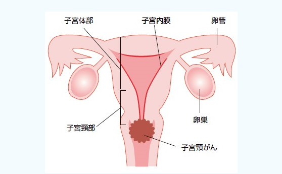 宫颈癌前沿治疗