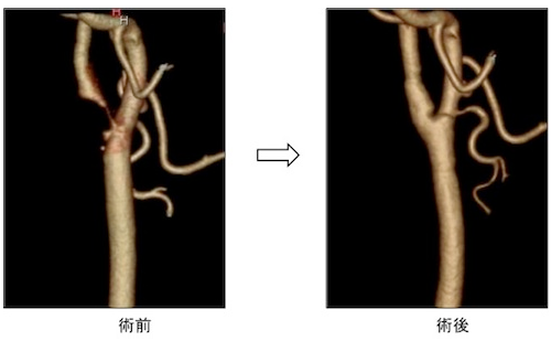 颈动脉狭窄