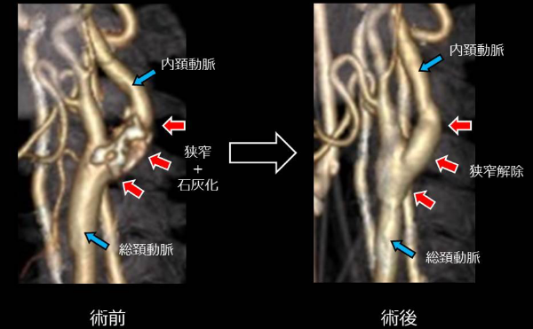 重度颈动脉狭窄治疗方法