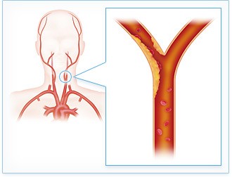 老年人重度颈动脉狭窄