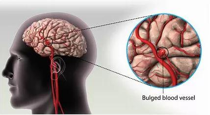 脑动脉瘤治疗,脑动脉瘤,脑动脉瘤复发风险