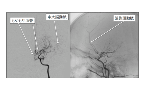 烟雾病脑出血治疗方法