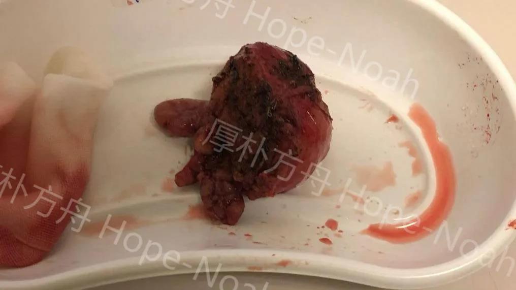 前列腺癌达芬奇手术