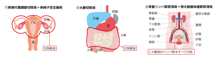 日本卵巢癌治疗