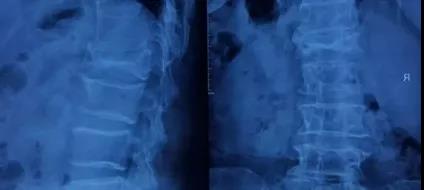 赫尼克治疗腰椎间盘突出