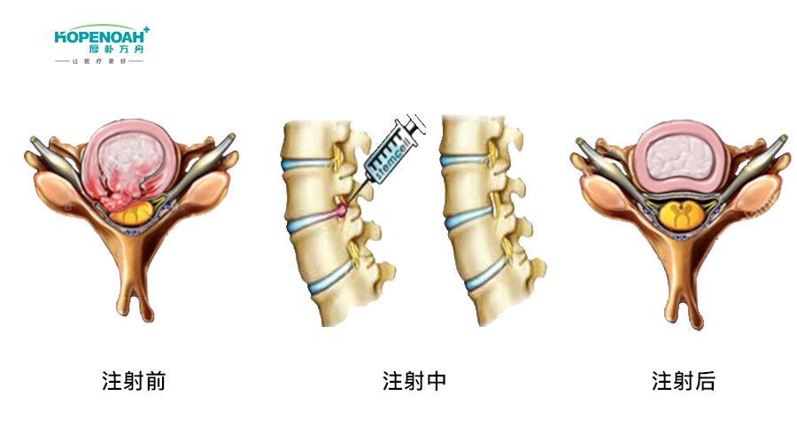 腰椎间盘突出治疗流程