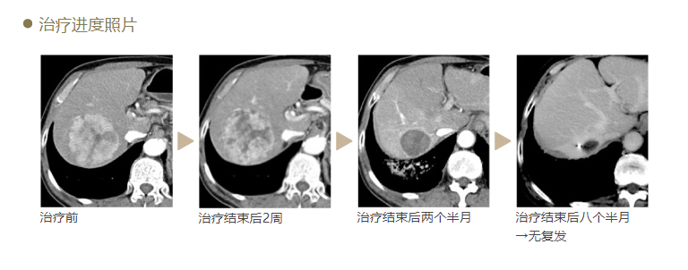 肝癌治疗的效果