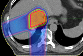 质子治疗肝癌的剂量分布