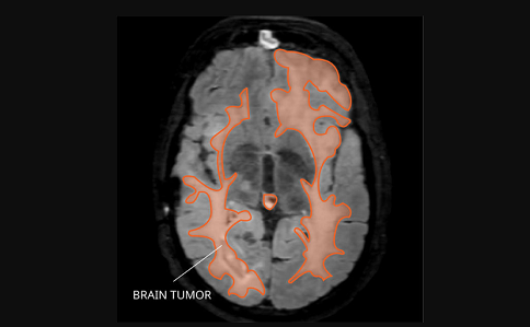 脑胶质瘤能活多久