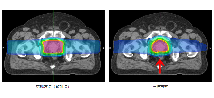 质子治疗前列腺癌的剂量分布